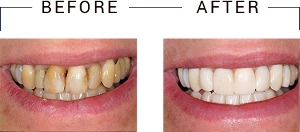 Benson Family Dentistry | Crowns  amp  Caps, Veneers and Paperless Charting